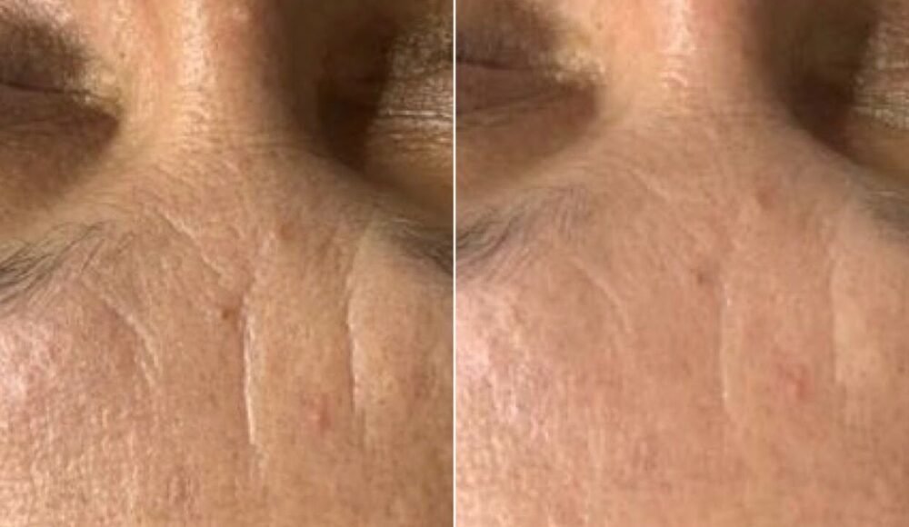 RADIOFRECUENCIA FACIAL - Imagen 2